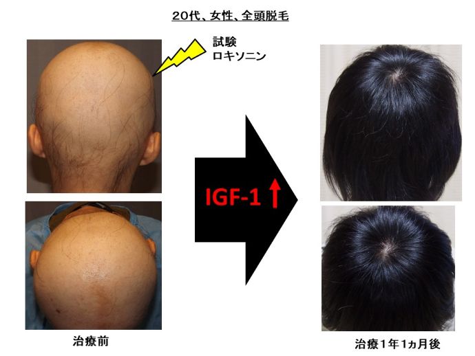 円形脱毛症　病院